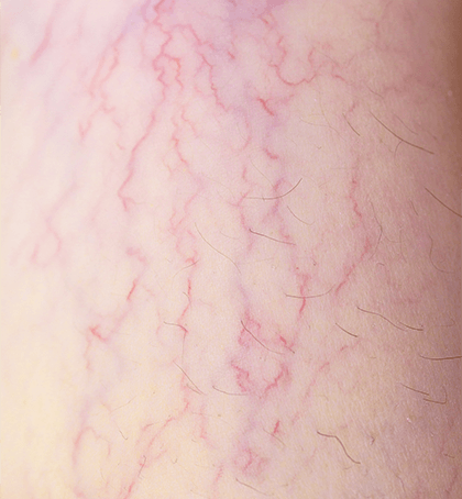 Dr Flora Skin Health Spider Vein Treatment