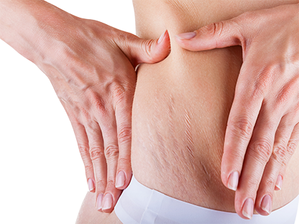 Dr Flora Skin Health Stretch Marks