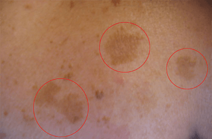 Dr Flora Skin Health  Melasma Treatment