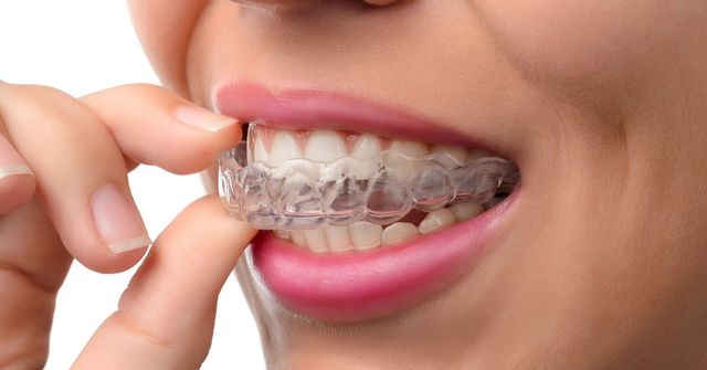 Where to find Invisalign Braces