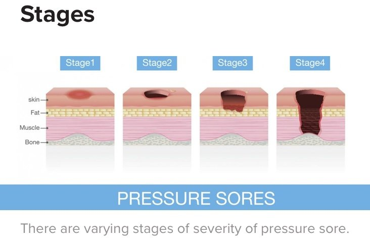 BED SORES: WHAT WE SHOULD KNOW!