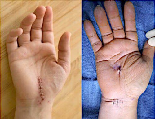 Carpal Tunnel Surgery Recovery Instructions