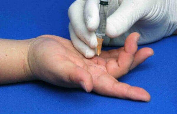 treatment-for-dupuytren-s-contracture