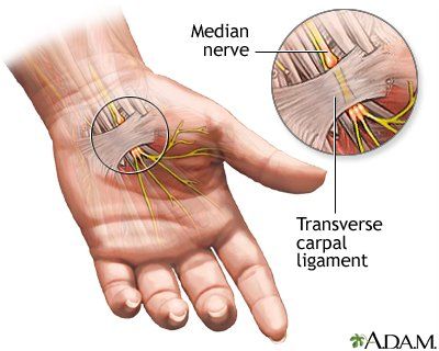 Carpal Tunnel Release