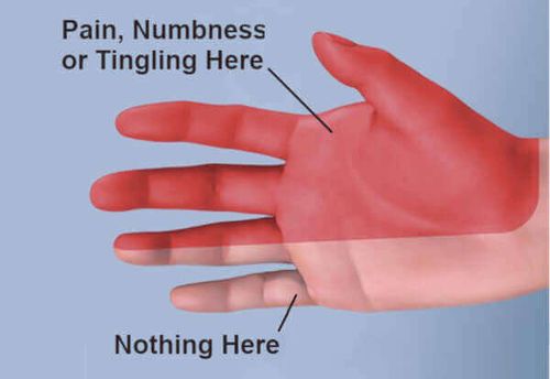 Signs of Carpal Tunnel