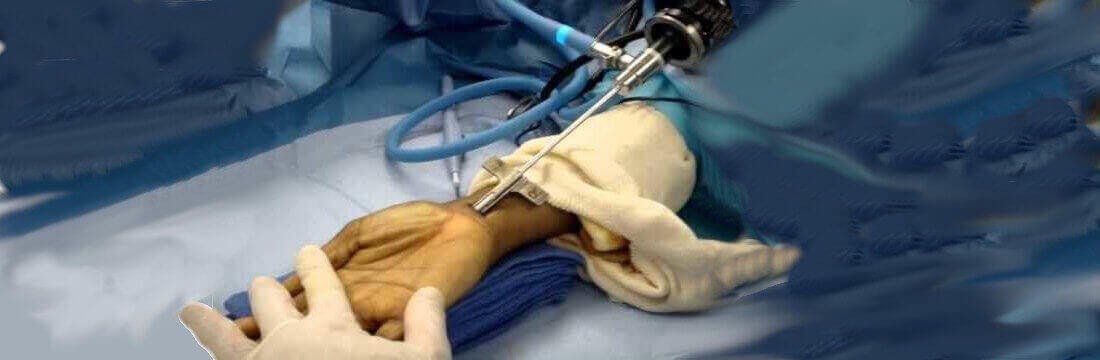 endoscopic-carpal-tunnel-surgery