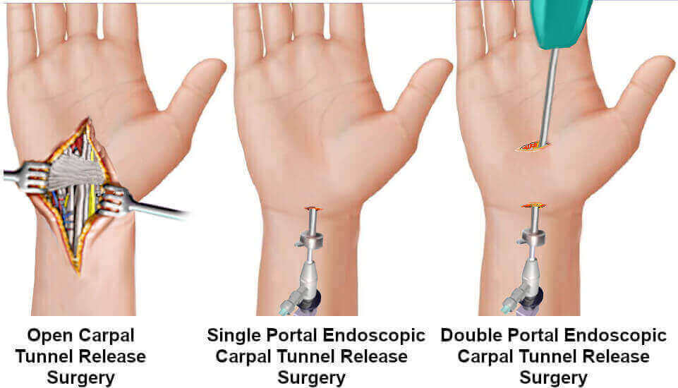 surgery carpal tunnel