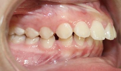 Protruding Teeth Information in Doncaster | E Orthodontics