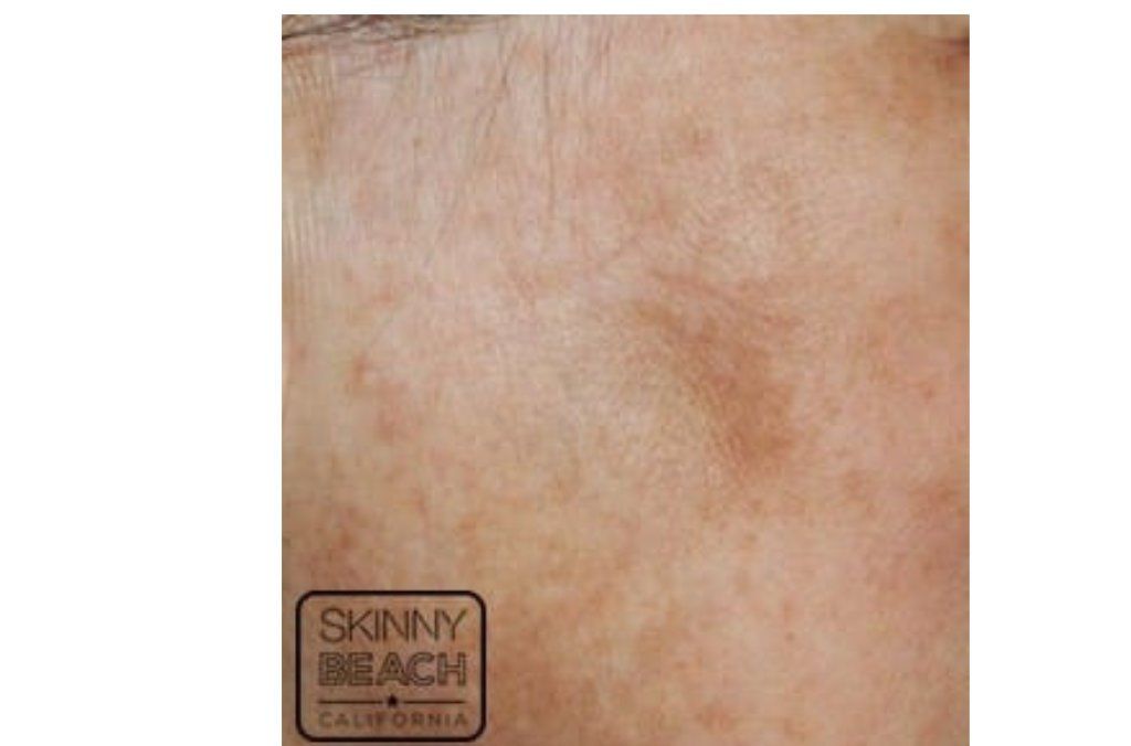 Clarity Laser Treatment San Diego Skin and Hair Removal CA