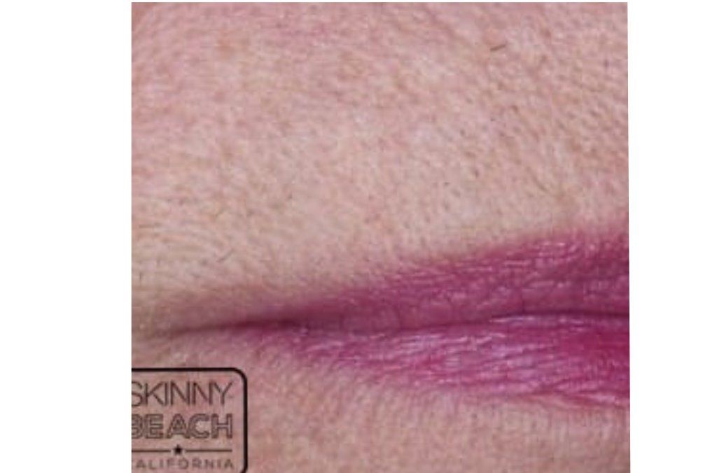 Clarity Laser Treatment San Diego Skin and Hair Removal CA