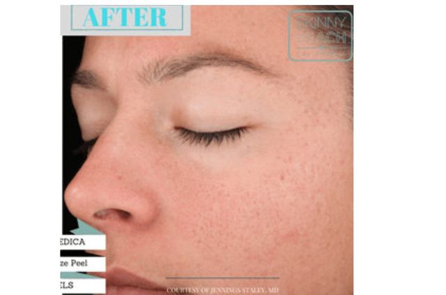 Rejuvenize Peel San Diego Skinmedica Peels Ca