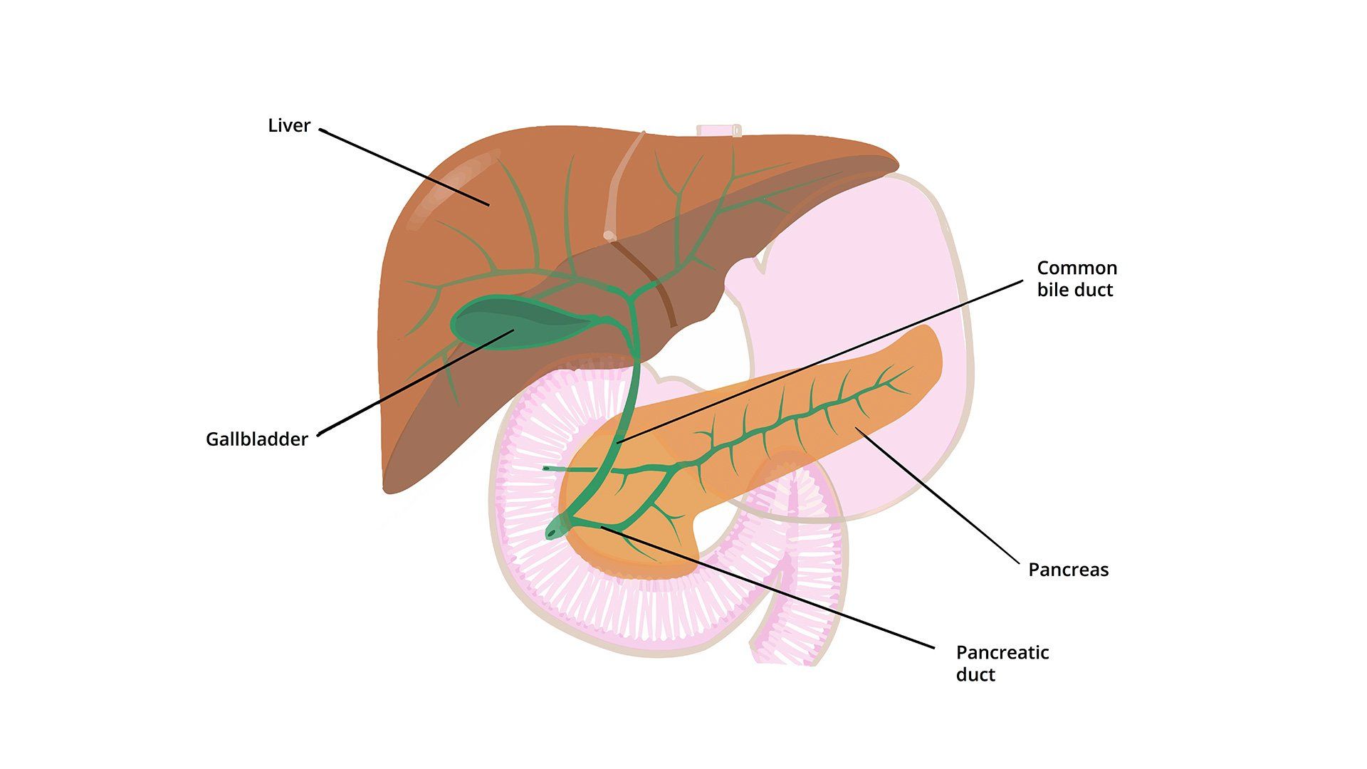 gallstones-generally-not-dangerous-but-caution-called-for-in-certain-cases