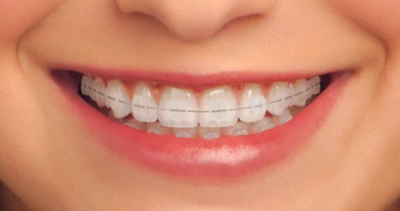 Delgado Orthodontics Braces & Invisalign in North