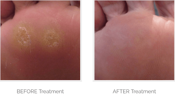 Verruca Images Before And After Treatment Demonstrate The Effectiveness verruca-images-before-and-after-treatment-demonstrate-the-effectiveness