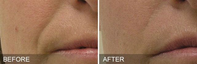 Hydrafacials