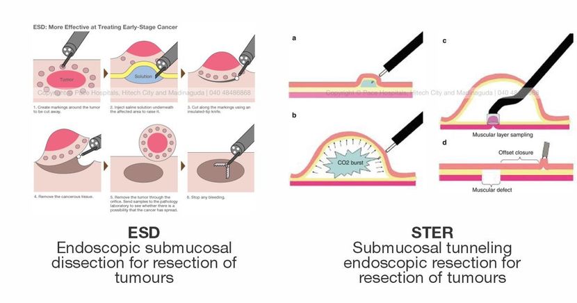 Endoscopic Surgery: A revolution in treatment in gastrointestinal disorders