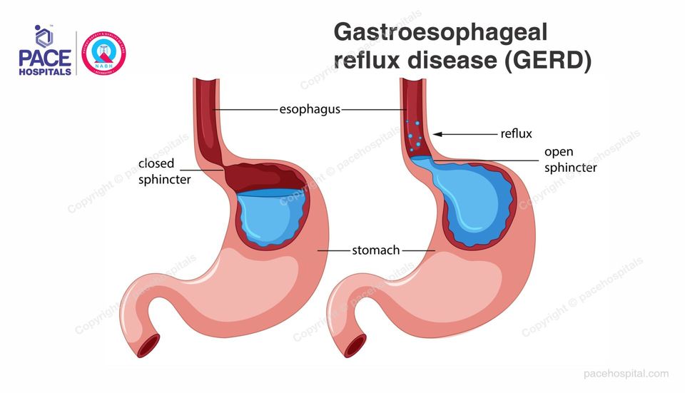 Gastroesophageal Reflux Disease Gerd Symptoms Causes Diagnosis And Treatment 