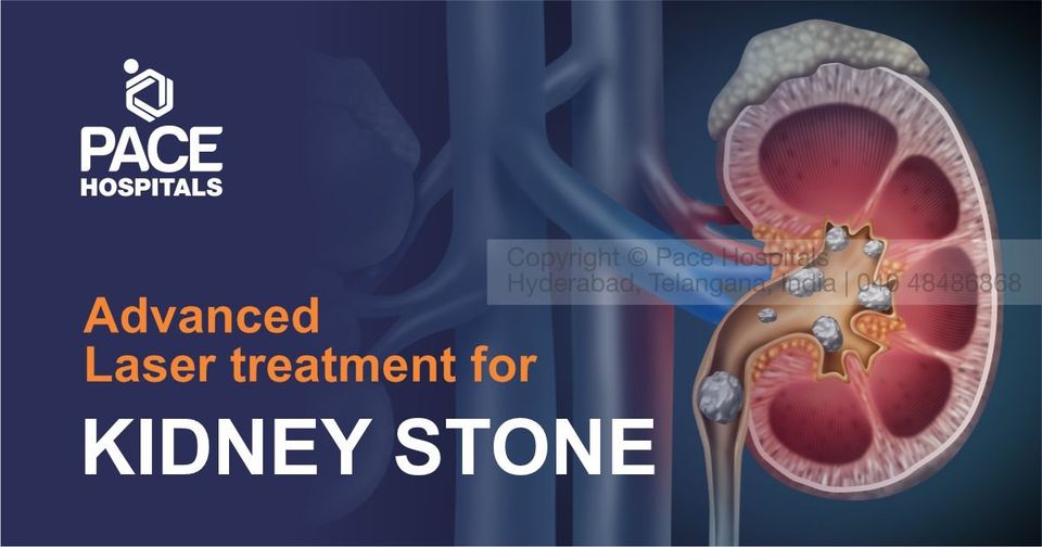What are Kidney Stones and What are the options for kidney stone treatment?