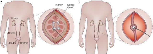 Left Laparoscopic Ureterolithotomy