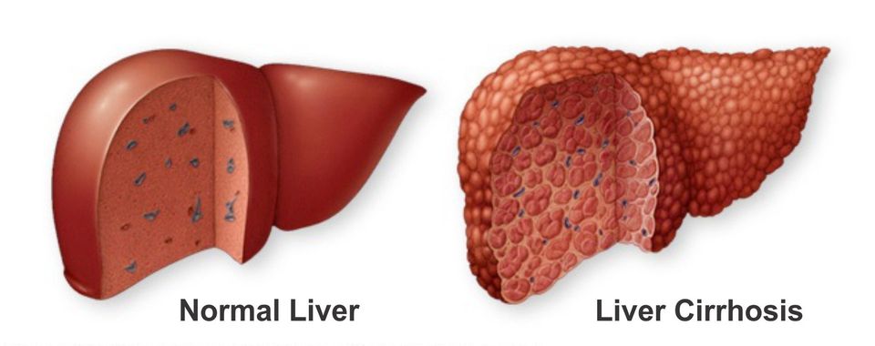 Liver Cirrhosis - Symptoms, Causes And Prevention