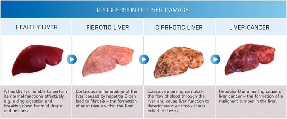 Risk Prevention And Screening Of Liver Cancer 1600