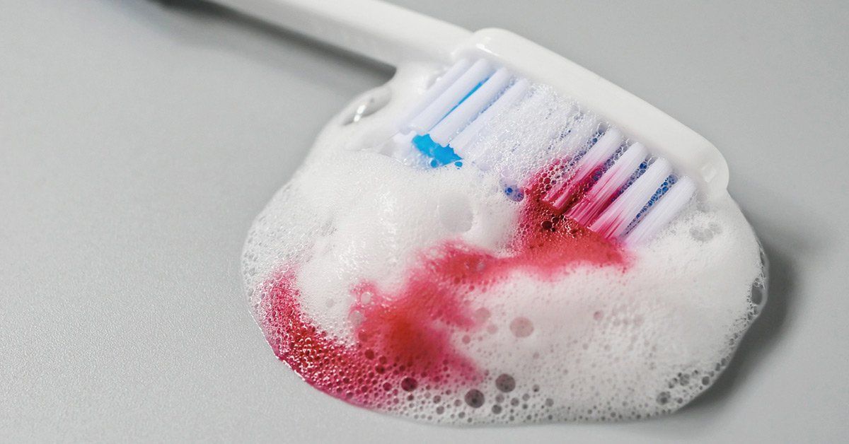 Bleeding Gums Causes and Treatments