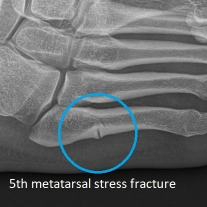 insoles for metatarsal fracture