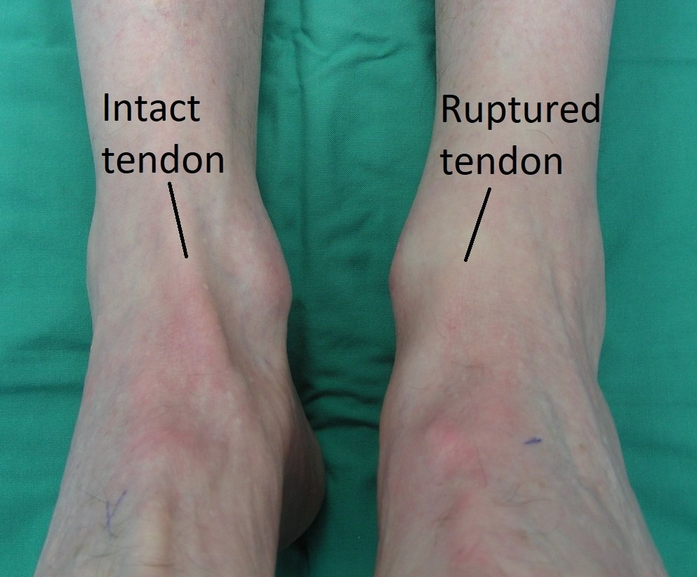 Ankle Tendon Dr Ben Beamond Orthopaedic Surgeon Adelaide