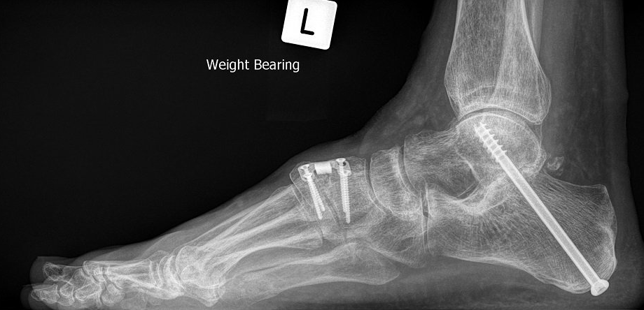 Flat Foot Reconstruction Dr Ben Beamond Orthopaedic Surgeon Adelaide