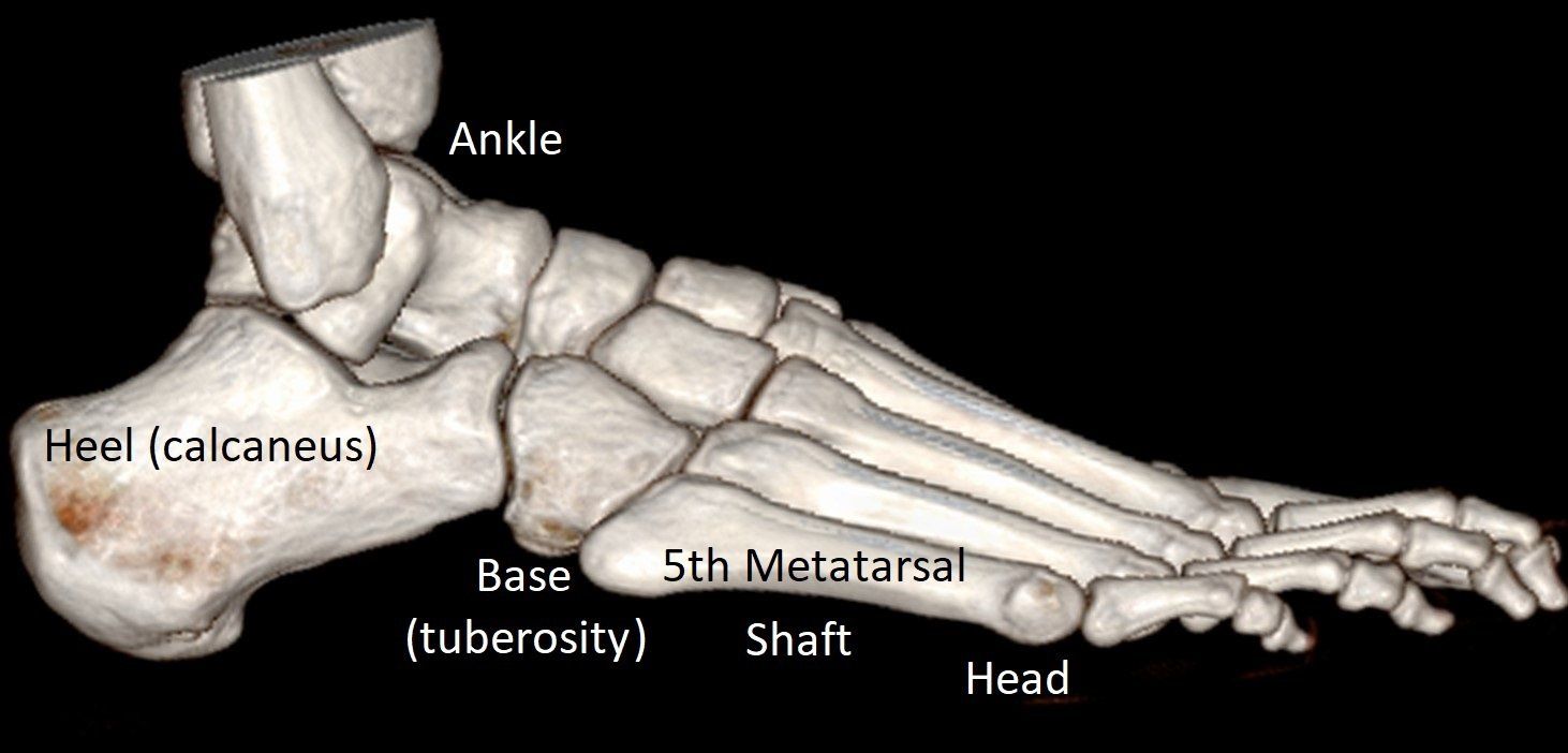 5th Metatarsal Fracture | Dr Ben Beamond | Orthopaedic Surgeon | Adelaide