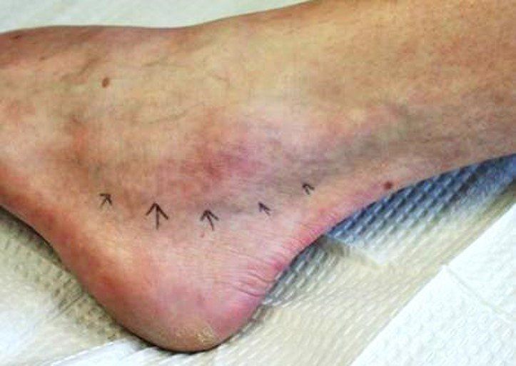 Ankle Tendon Dr Ben Beamond Orthopaedic Surgeon Adelaide