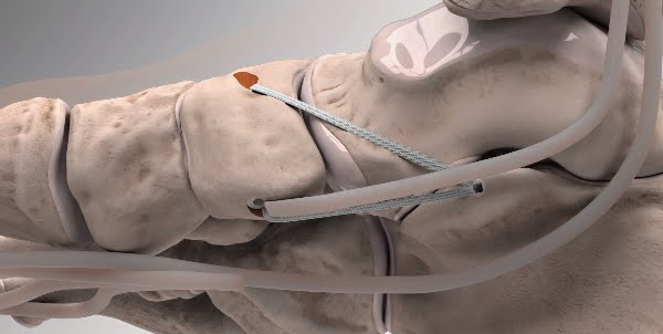 flat foot reconstruction surgery recovery flat foot reconstruction surgery recovery