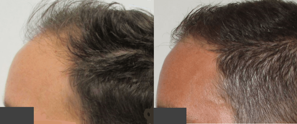 How Long Does Hair Regrowth Take?