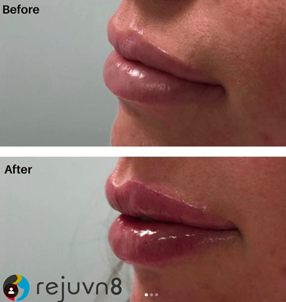 Rejuvn8 Lip Filler
