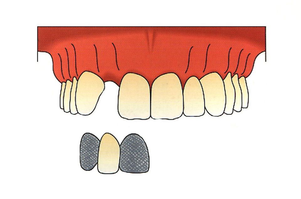 Resin Bonded Bridges Greenwood Grincare Wellington Dentists