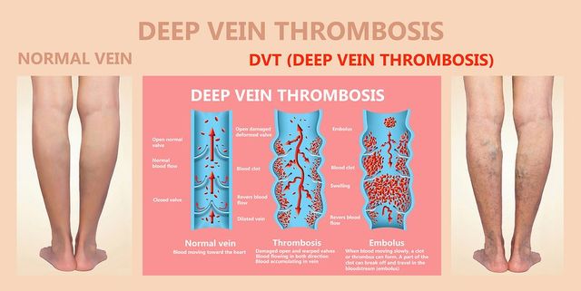 Knowing Your Risk For Dvt