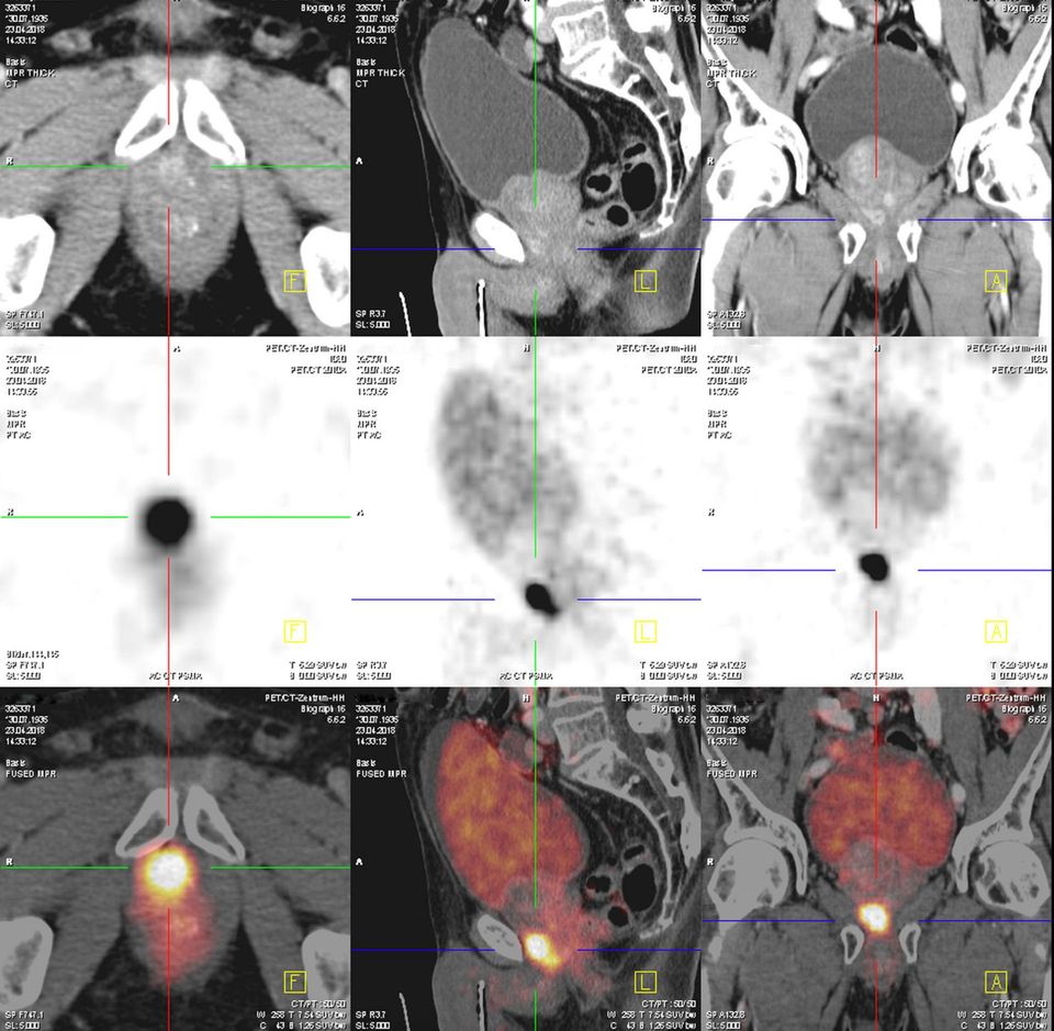 PSMA-PET/CT