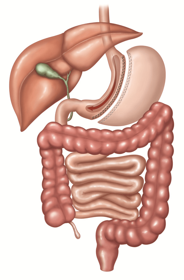 Endoscopic Sleeve Gastroplasty