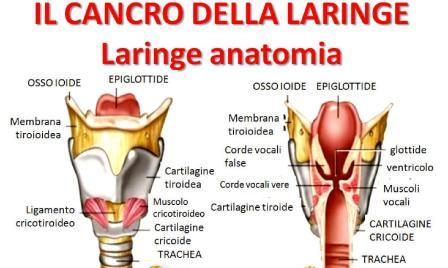 Cancro della Laringe