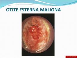 Otite esterna maligna