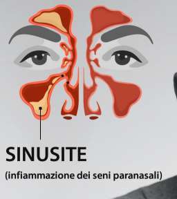 sinusite