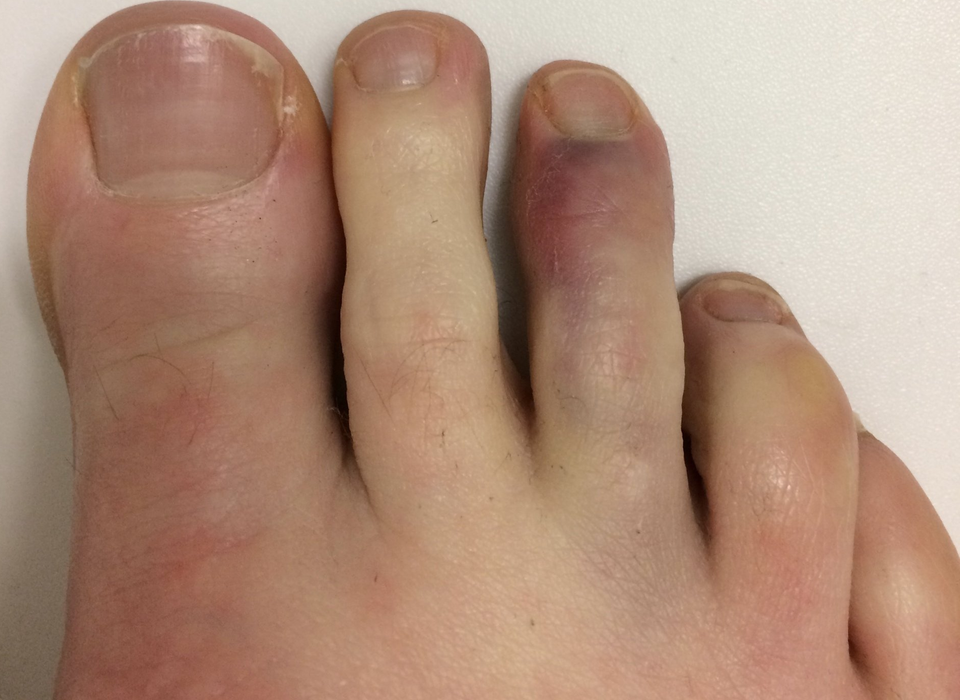 broken-toe