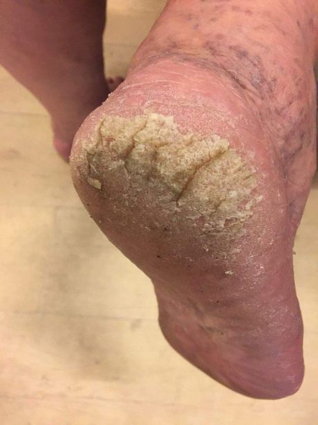 Diabetisch en Risico voet