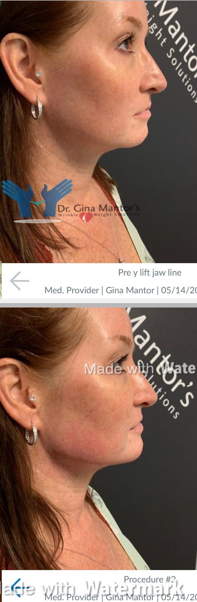 YLiftLiquid Facelift Procedure Columbus, OH Dr. Mantor's Wrinkle