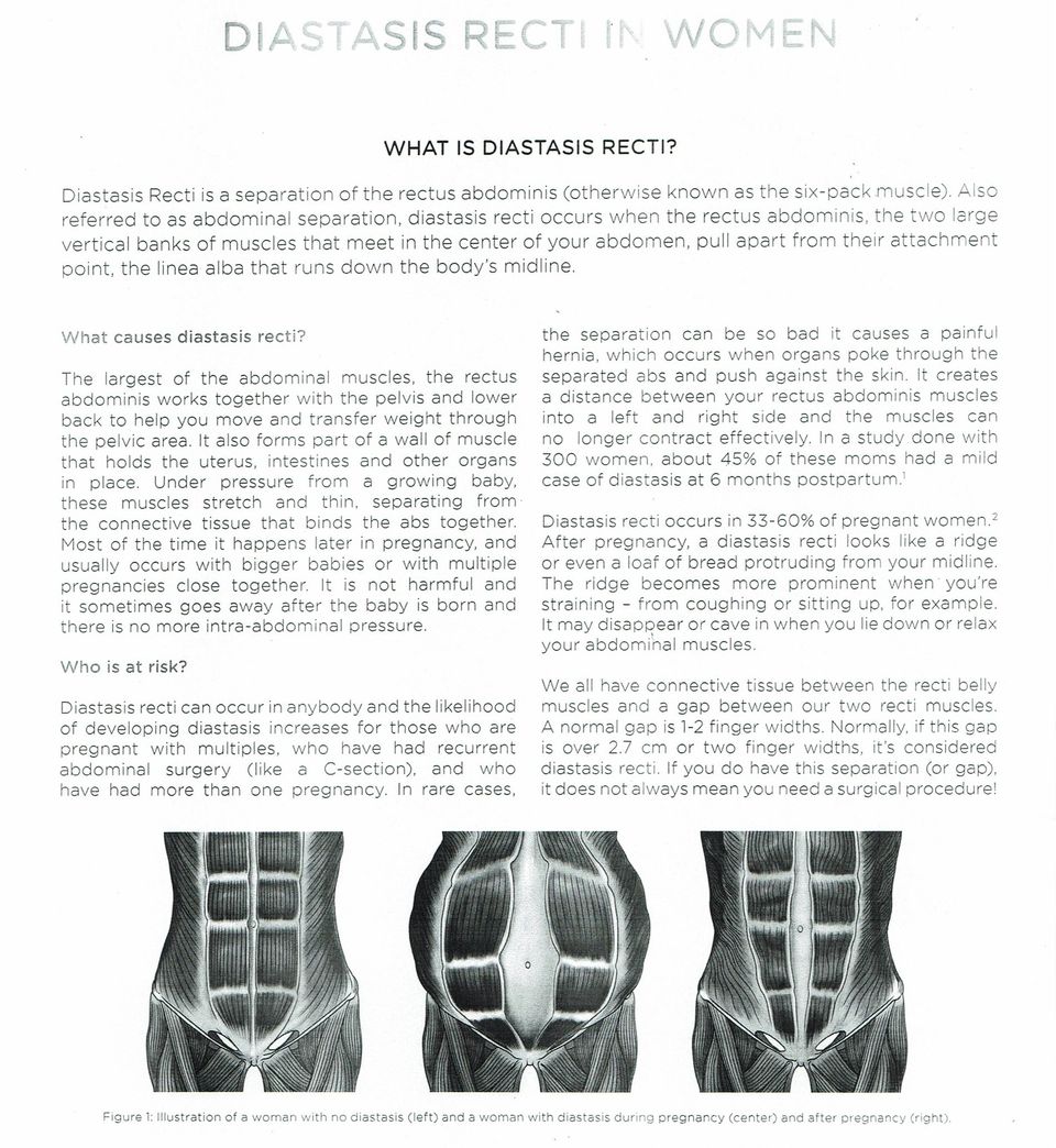 Diastasis Recti In Woman - EMSCULPT treatment can help!