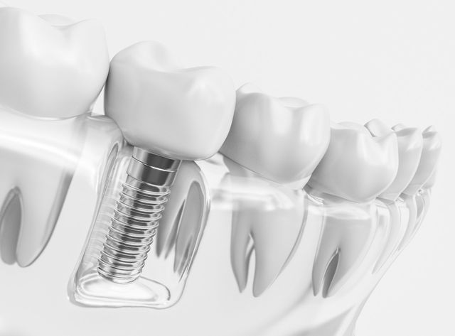 dental implants dentist Scottsdale