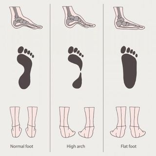 flat feet pronation