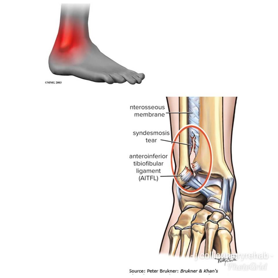 ankle-syndesmosis