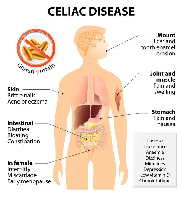 celiac-disease-treatments-natural-remedies-nutrition-wellness-center