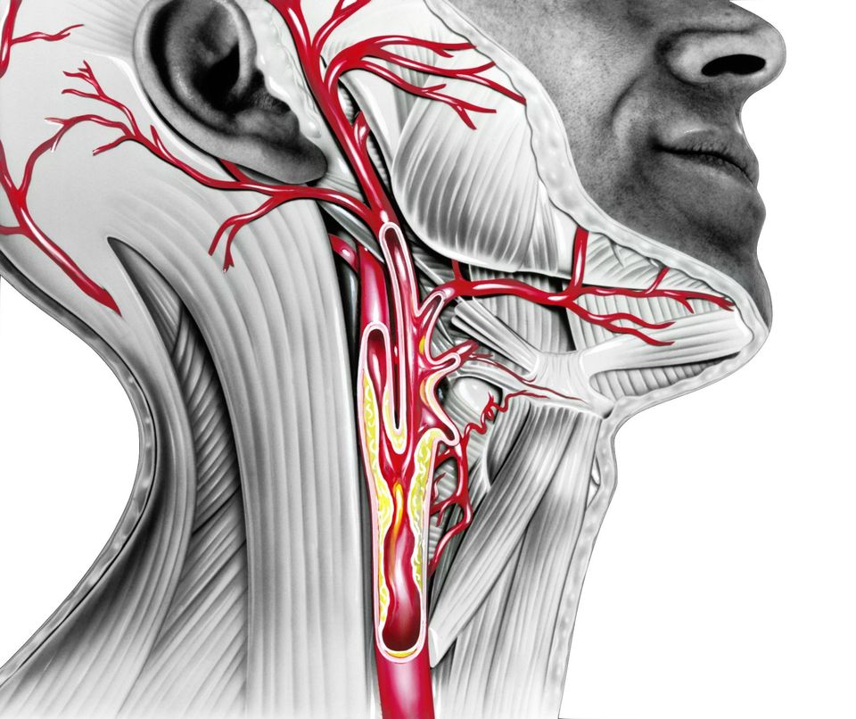 LESIÓN DE ARTERIA CAROTIDA